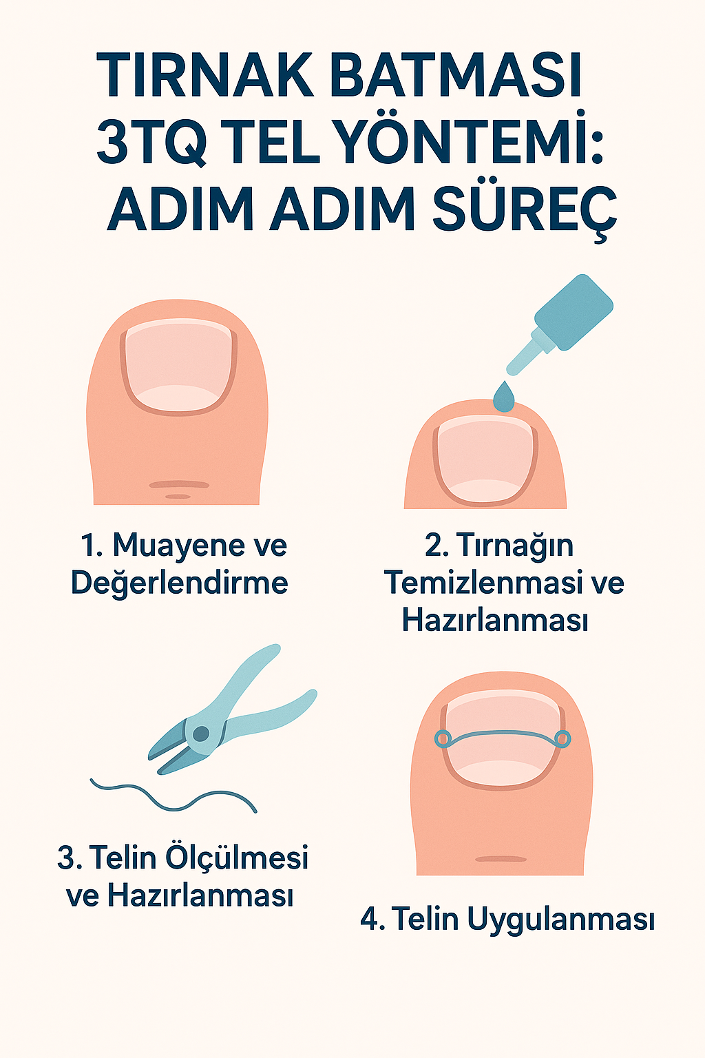 Tırnak Batması 3TQ Tel Yöntemi: Adım Adım Süreç